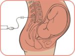 Tatuajes y anestesia epidural, ¿riesgo o exageración?