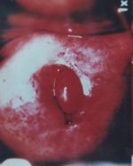 Síntomas y signos de la infección por VPH