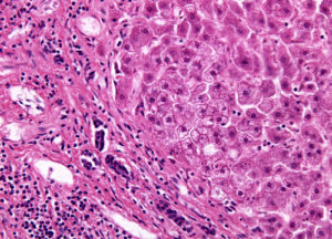 Microscopía del hígado mostrando hepatitis.