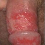 Herpes genital