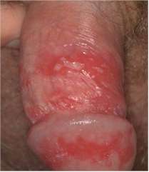 Herpes genital