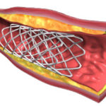 Stent