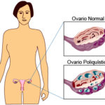 Los ovarios poliquísticos son la causa más común de infertilidad femenina