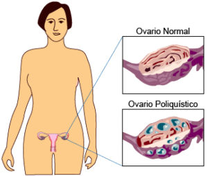 Los ovarios poliquísticos son la causa más común de infertilidad femenina