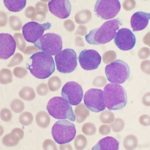 El trasplante de células madre aumenta la supervivencia en pacientes con leucemia
