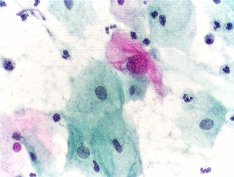 Estudio de pap con células claramente anormales