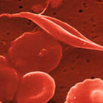 Descubren que 2 unidades de sangre de cordón umbilical reducen el riesgo de recurrencia de leucemia
