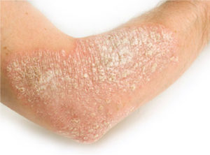 La Sociedad Argentina de Dermatología informa que hay cerca de 800.000 pacientes con esta enfermedad en nuestro país.
