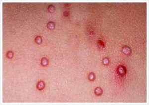 Molusco Contagioso